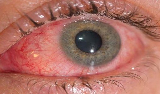 Conjuntivite – Causas, Sintomas e Como Tratar