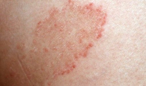 Impingem – Causas, Sintomas e Tratamento