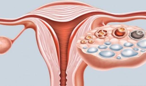 Qual a diferença entre cisto e tumor?
